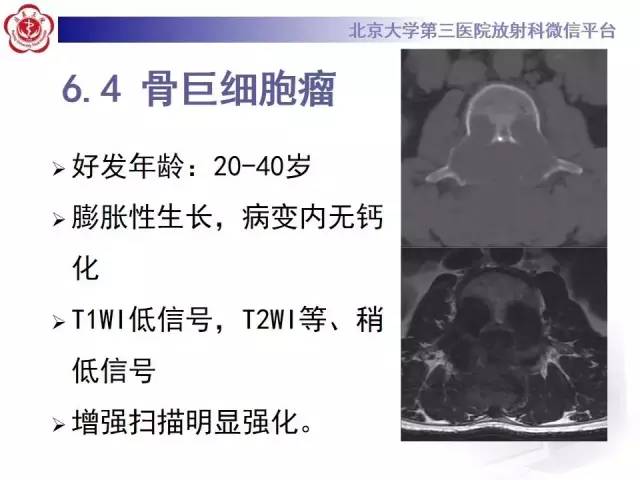 【病例】脊柱朗格汉斯组织细胞增生症1例CT及MR影像诊断