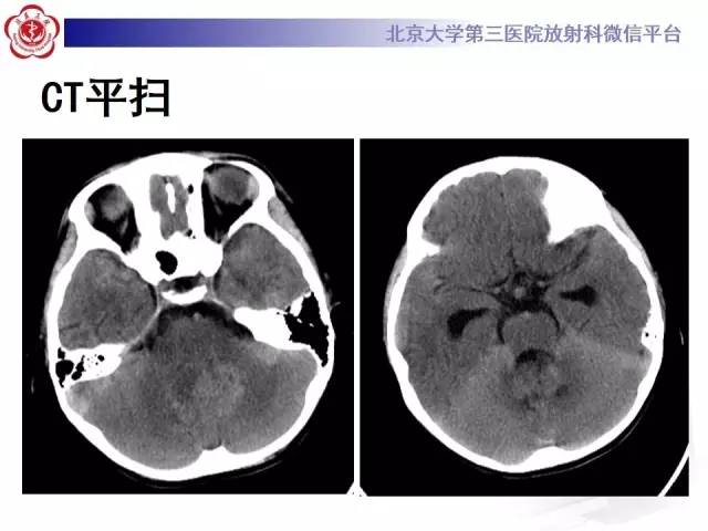 【病例】髓母细胞瘤1例CT及MR影像诊断