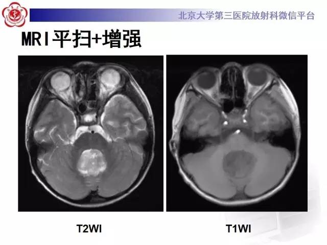【病例】髓母细胞瘤1例CT及MR影像诊断