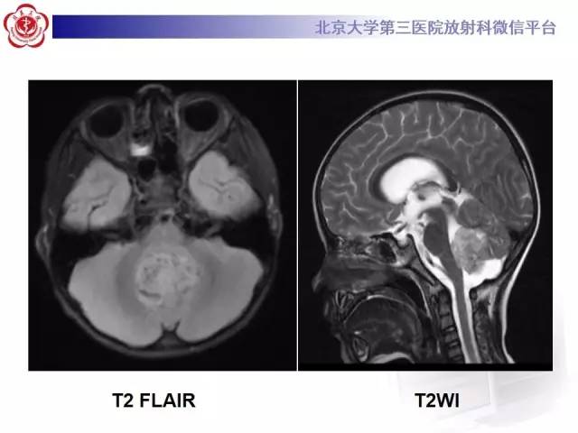 【病例】髓母细胞瘤1例CT及MR影像诊断