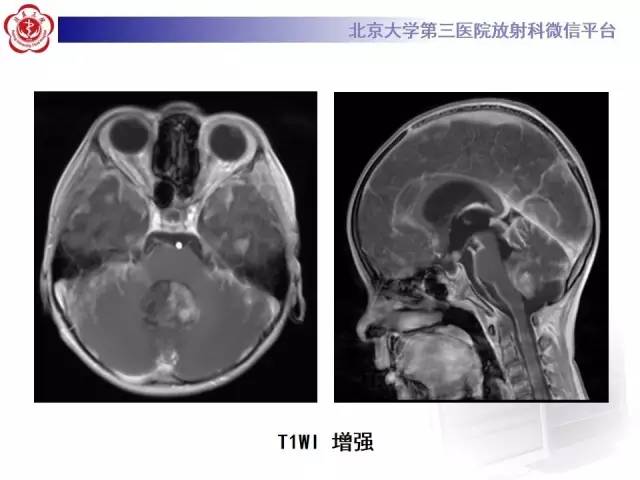 【病例】髓母细胞瘤1例CT及MR影像诊断