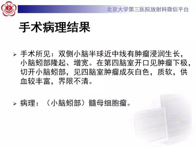 【病例】髓母细胞瘤1例CT及MR影像诊断