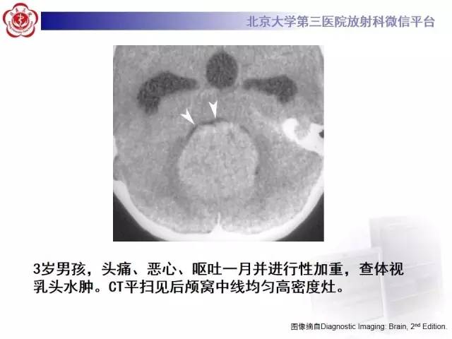 【病例】髓母细胞瘤1例CT及MR影像诊断