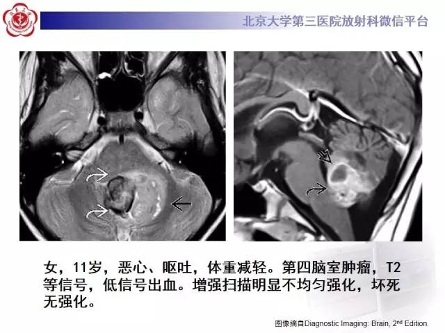 【病例】髓母细胞瘤1例CT及MR影像诊断