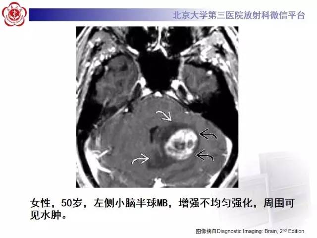 【病例】髓母细胞瘤1例CT及MR影像诊断
