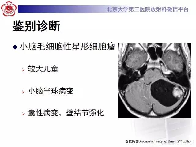 【病例】髓母细胞瘤1例CT及MR影像诊断