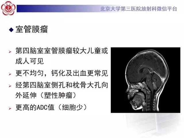 【病例】髓母细胞瘤1例CT及MR影像诊断