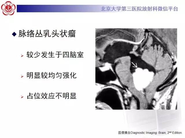 【病例】髓母细胞瘤1例CT及MR影像诊断