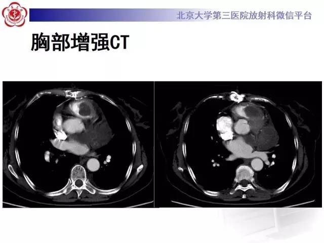 【病例】心脏原发性肿瘤1例CT影像表现