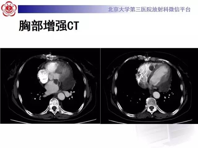 【病例】心脏原发性肿瘤1例CT影像表现