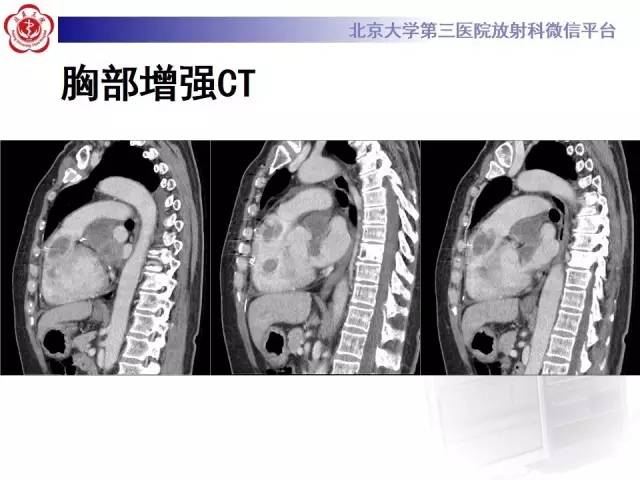 【病例】心脏原发性肿瘤1例CT影像表现