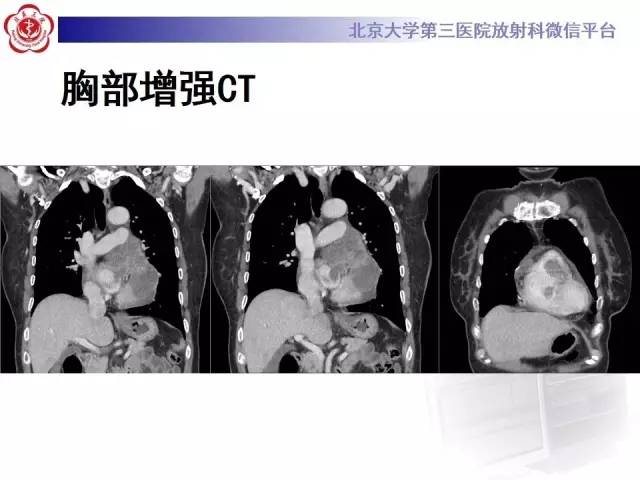 【病例】心脏原发性肿瘤1例CT影像表现