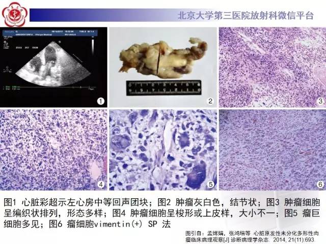 【病例】心脏原发性肿瘤1例CT影像表现