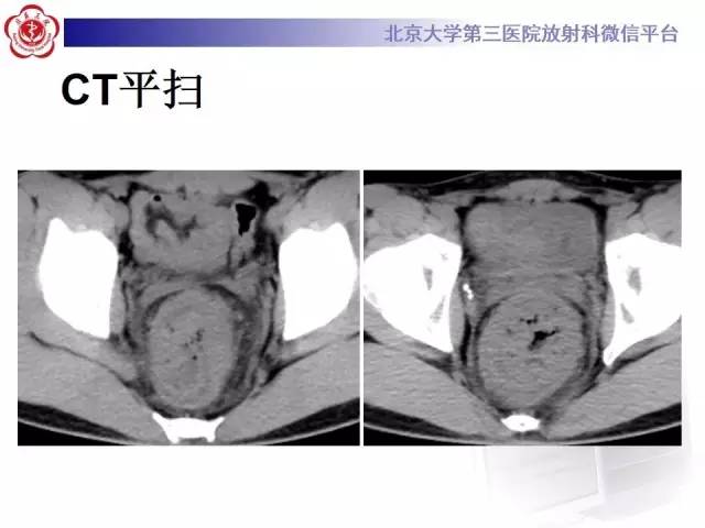 【病例】直肠孤立性溃疡1例CT及MR影像诊断