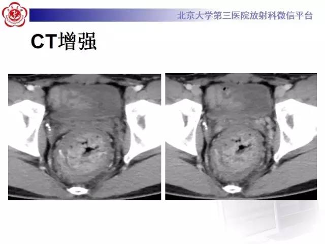 【病例】直肠孤立性溃疡1例CT及MR影像诊断