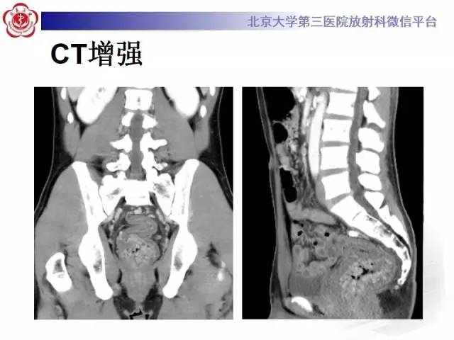 【病例】直肠孤立性溃疡1例CT及MR影像诊断