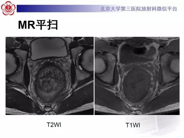 【病例】直肠孤立性溃疡1例CT及MR影像诊断
