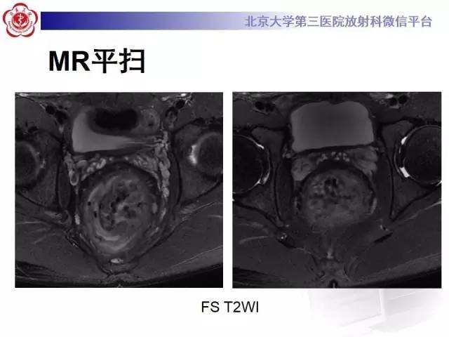 【病例】直肠孤立性溃疡1例CT及MR影像诊断