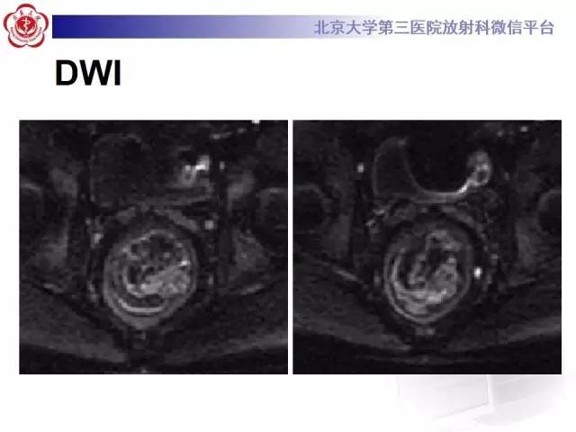【病例】直肠孤立性溃疡1例CT及MR影像诊断