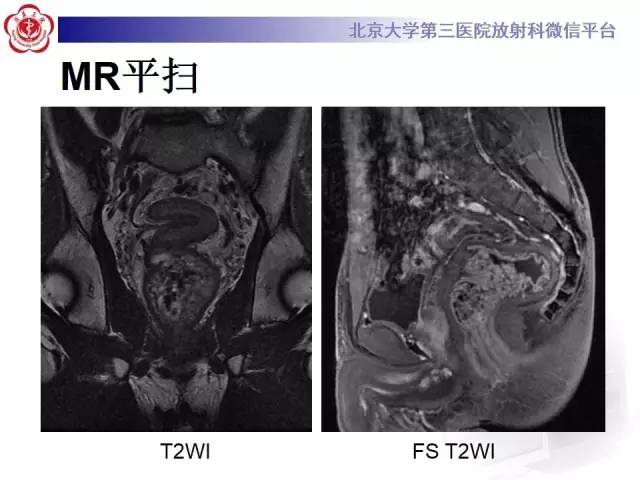 【病例】直肠孤立性溃疡1例CT及MR影像诊断