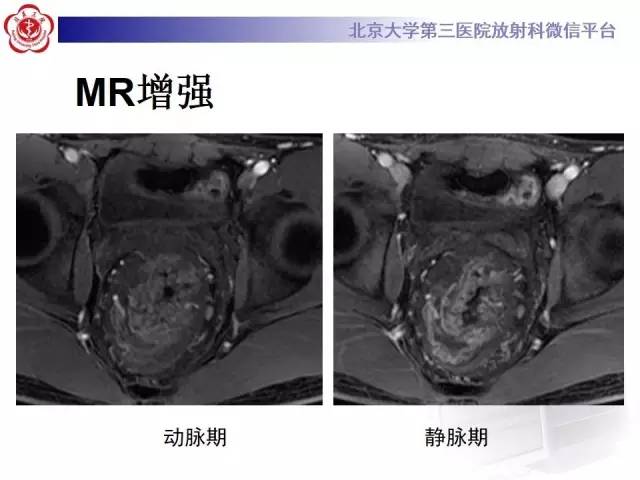 【病例】直肠孤立性溃疡1例CT及MR影像诊断