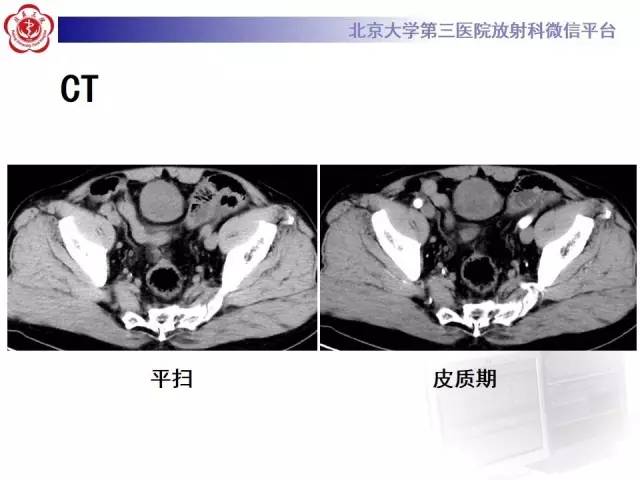 【病例】脐尿管癌1例CT影像诊断
