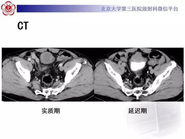 【病例】脐尿管癌1例CT影像诊断