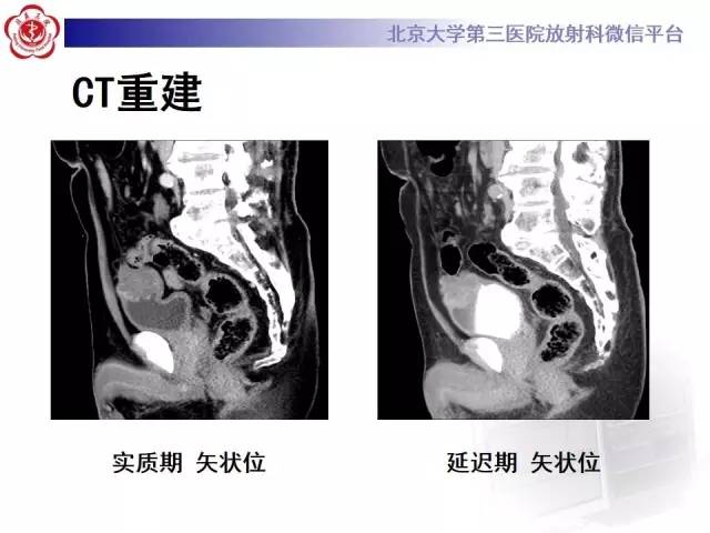 【病例】脐尿管癌1例CT影像诊断