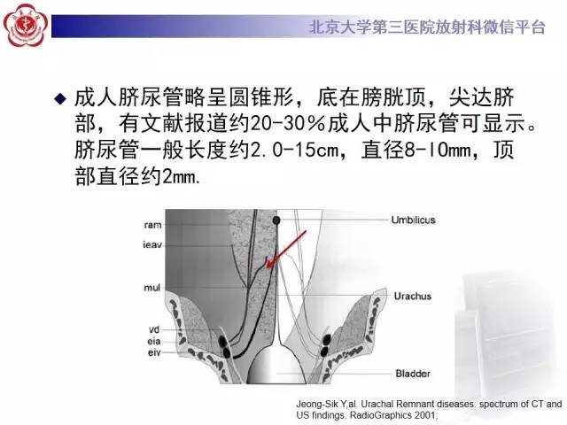 【病例】脐尿管癌1例CT影像诊断