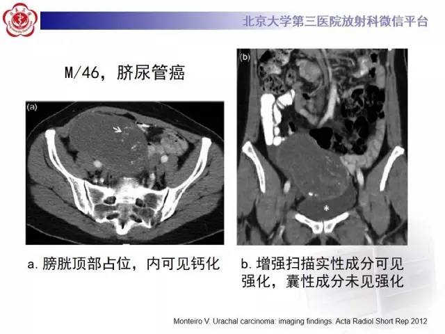【病例】脐尿管癌1例CT影像诊断