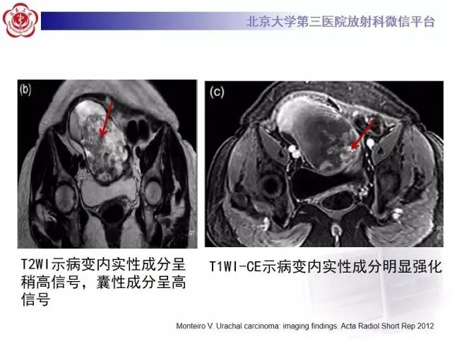 【病例】脐尿管癌1例CT影像诊断