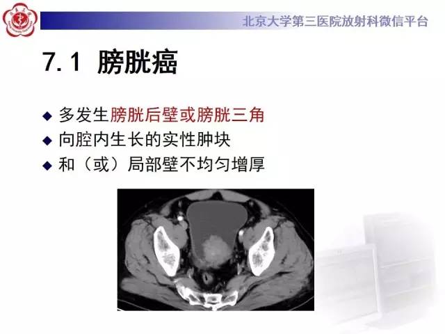 【病例】脐尿管癌1例CT影像诊断
