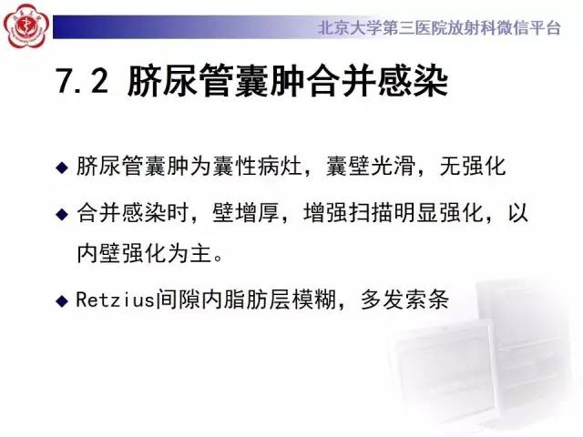 【病例】脐尿管癌1例CT影像诊断