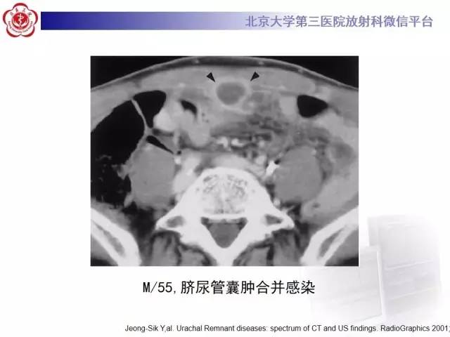 【病例】脐尿管癌1例CT影像诊断