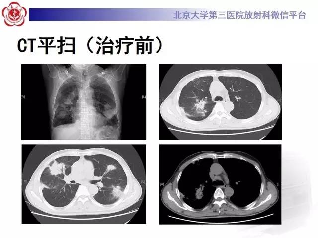 【病例】肺部肉芽肿性血管炎1例CT影像表现