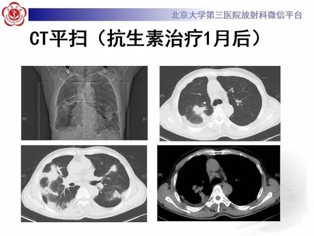 【病例】肺部肉芽肿性血管炎1例CT影像表现