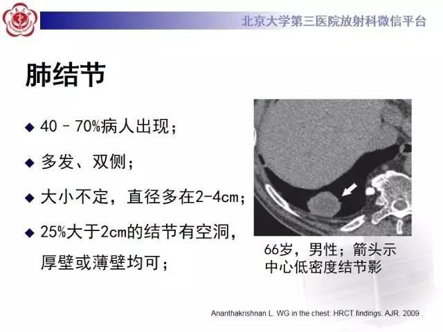 【病例】肺部肉芽肿性血管炎1例CT影像表现