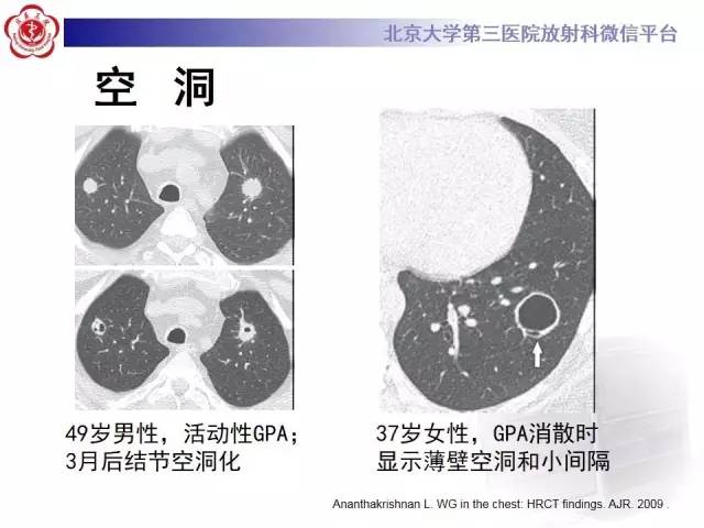 【病例】肺部肉芽肿性血管炎1例CT影像表现