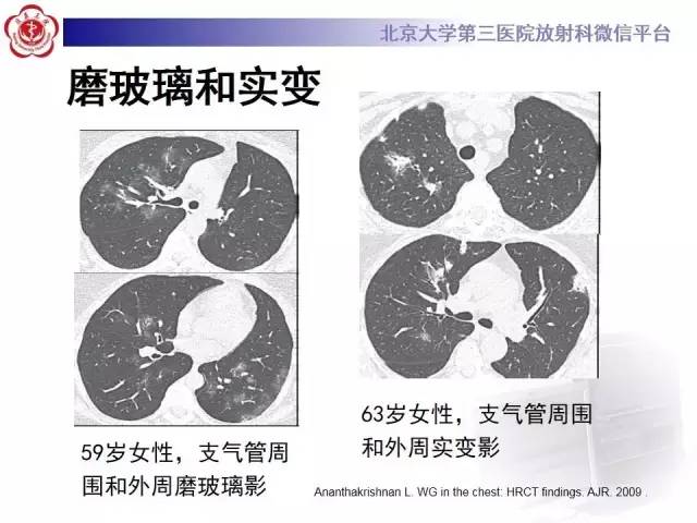 【病例】肺部肉芽肿性血管炎1例CT影像表现