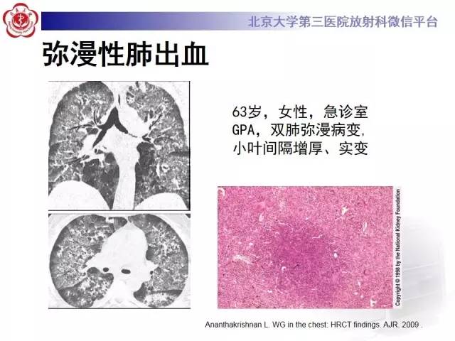 【病例】肺部肉芽肿性血管炎1例CT影像表现
