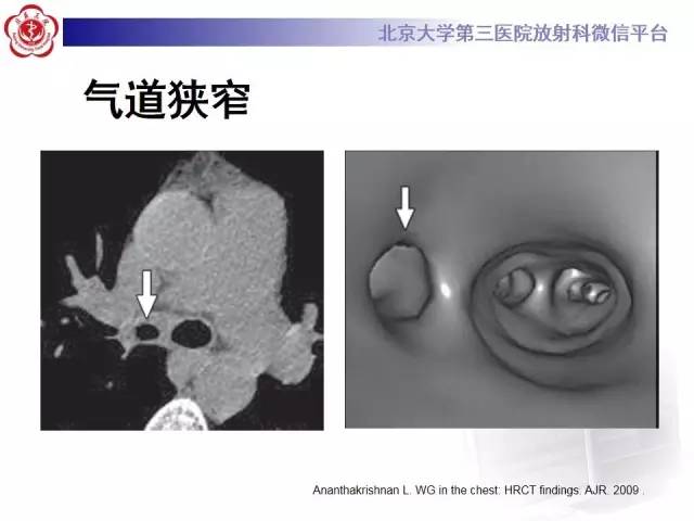 【病例】肺部肉芽肿性血管炎1例CT影像表现