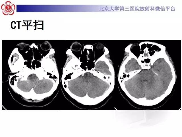 【病例】颅内静脉窦血栓形成1例CT及MR