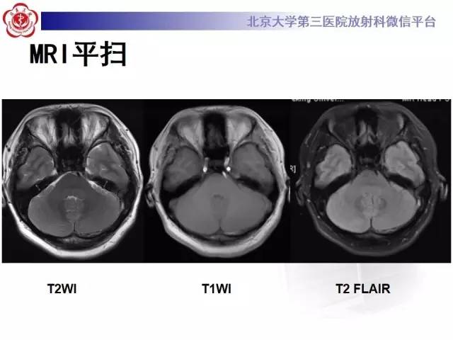 【病例】颅内静脉窦血栓形成1例CT及MR