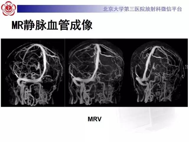 【病例】颅内静脉窦血栓形成1例CT及MR