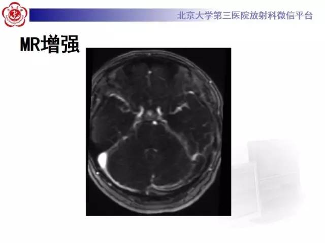 【病例】颅内静脉窦血栓形成1例CT及MR