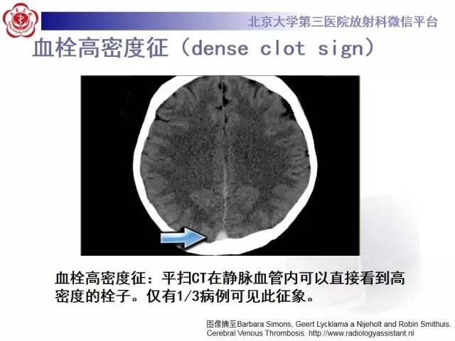 【病例】颅内静脉窦血栓形成1例CT及MR