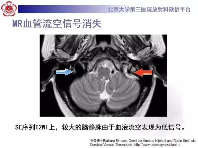 【病例】颅内静脉窦血栓形成1例CT及MR