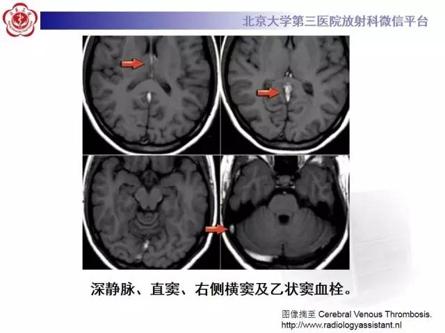 【病例】颅内静脉窦血栓形成1例CT及MR