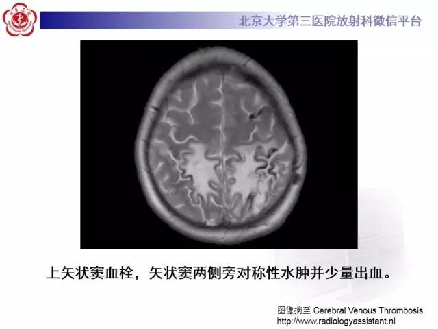 【病例】颅内静脉窦血栓形成1例CT及MR