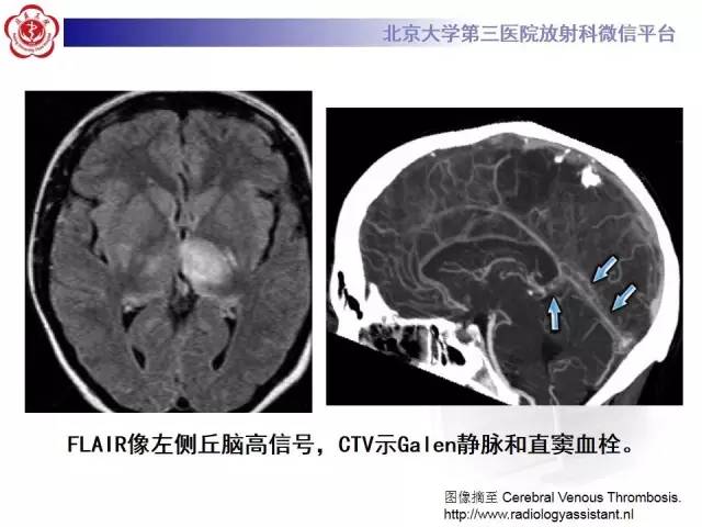 【病例】颅内静脉窦血栓形成1例CT及MR